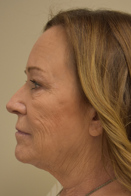 Natural Facelift Before and After | Northside Plastic Surgery