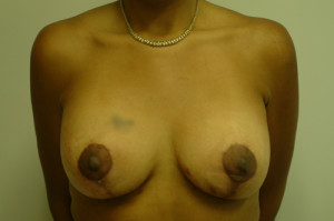 Breast Lift Atlanta