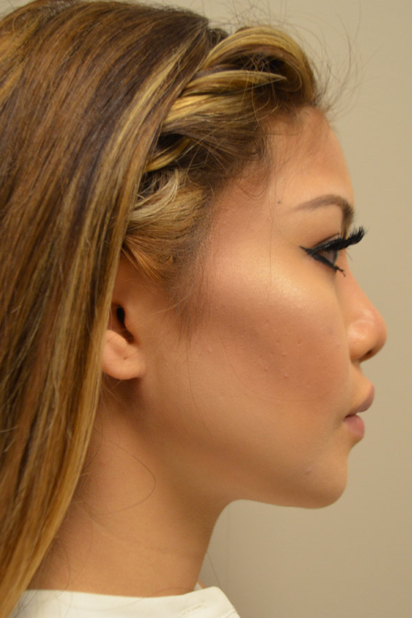 Ethnic Rhinoplasty Before and After | Northside Plastic Surgery