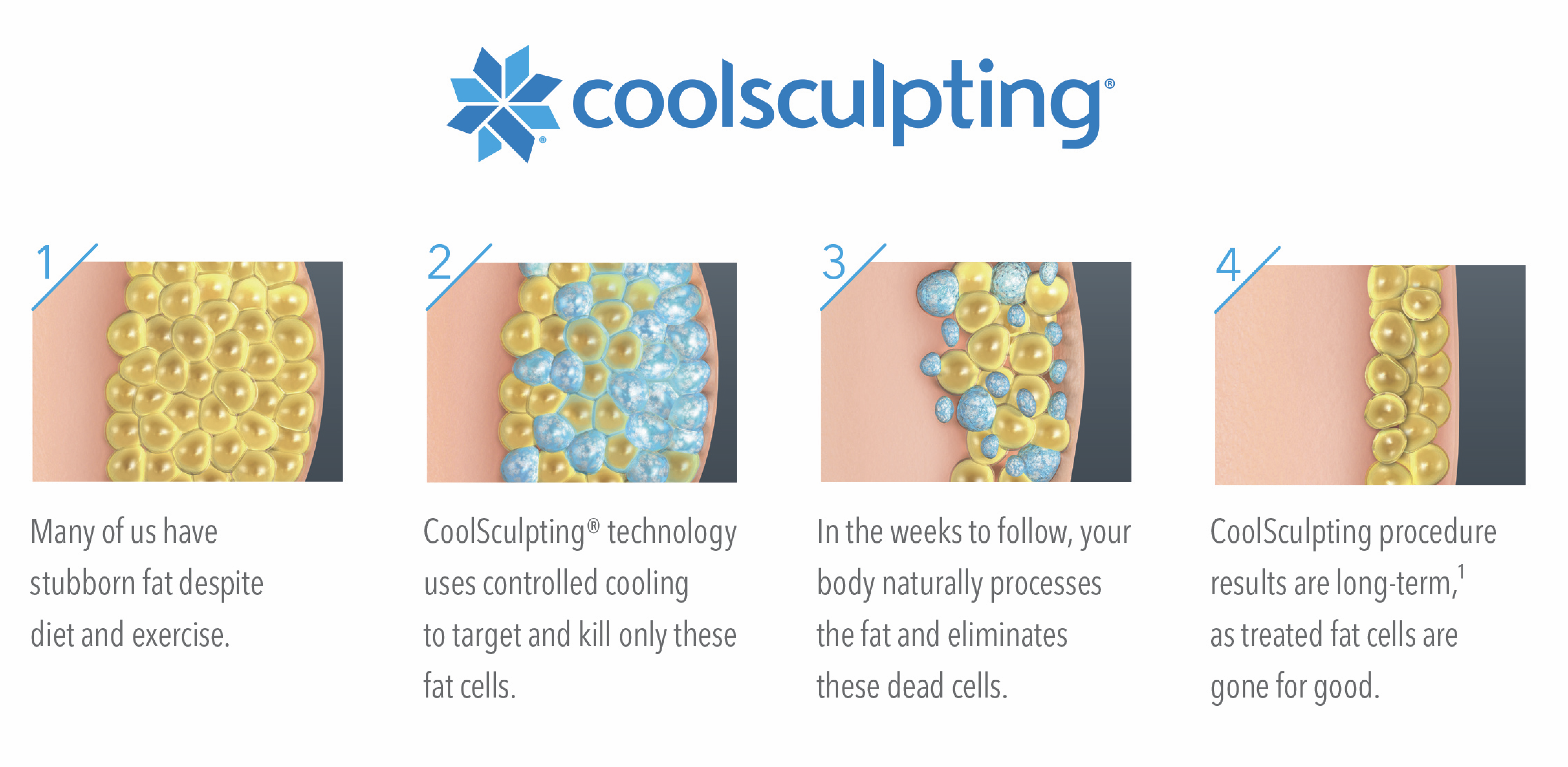 CoolSculpting Atlanta