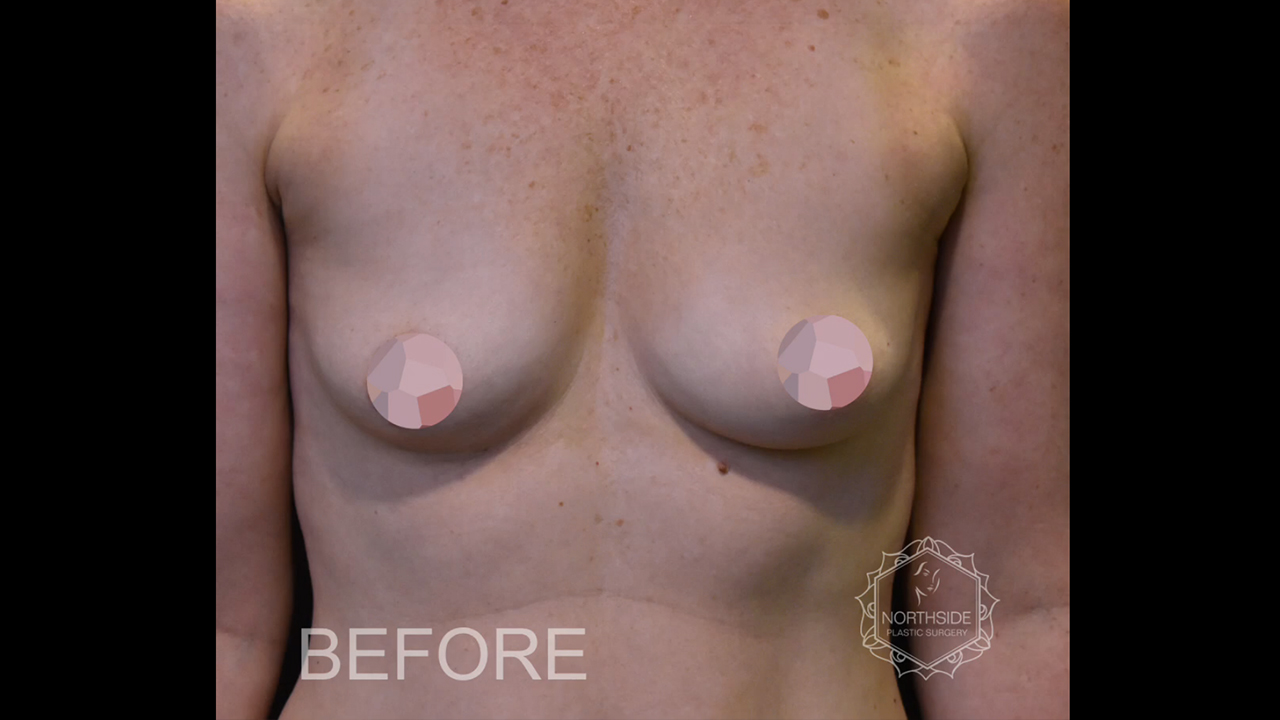 Breast Augmentation Atlanta