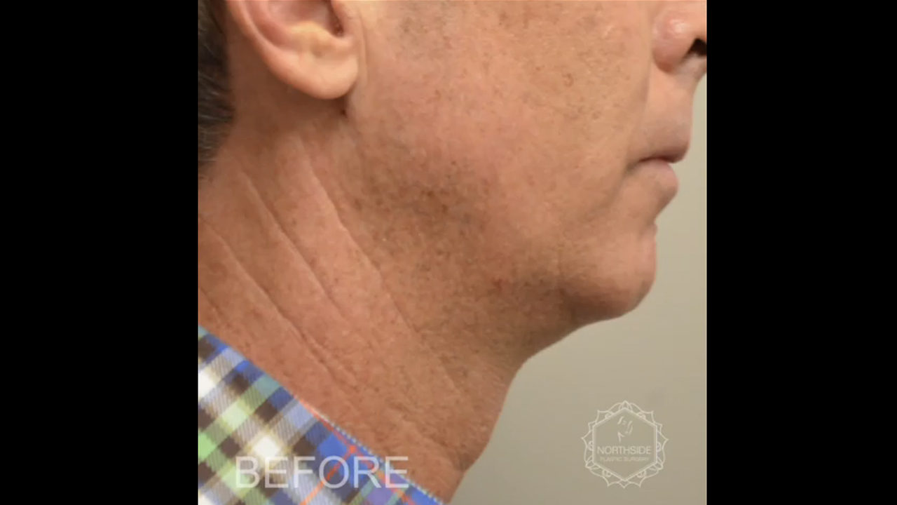 Chin Implant Surgery Atlanta