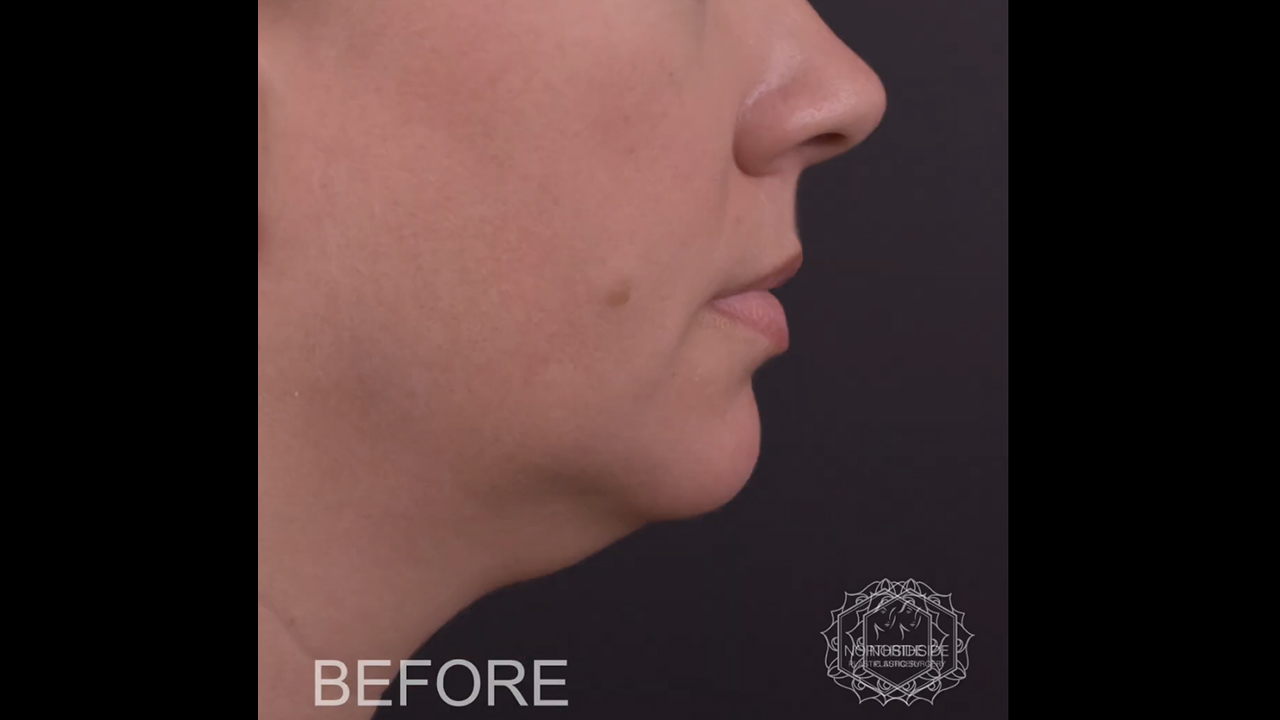 Neck Liposuction Atlanta