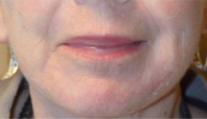 Perioral Dermabrasion Before and After | Northside Plastic Surgery