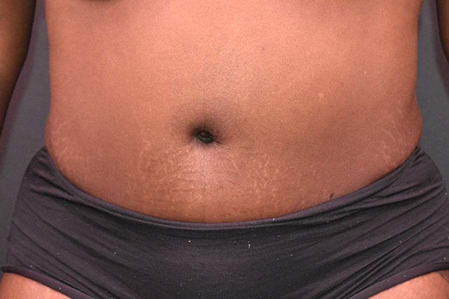 Abdominoplasty Before and After | Northside Plastic Surgery