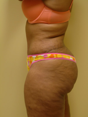 Abdominoplasty Before and After | Northside Plastic Surgery