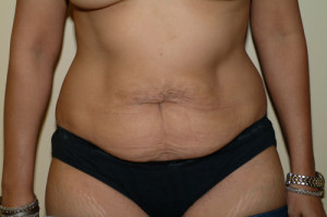 Abdominoplasty Before and After | Northside Plastic Surgery