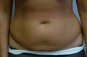 Abdominoplasty Before and After | Northside Plastic Surgery