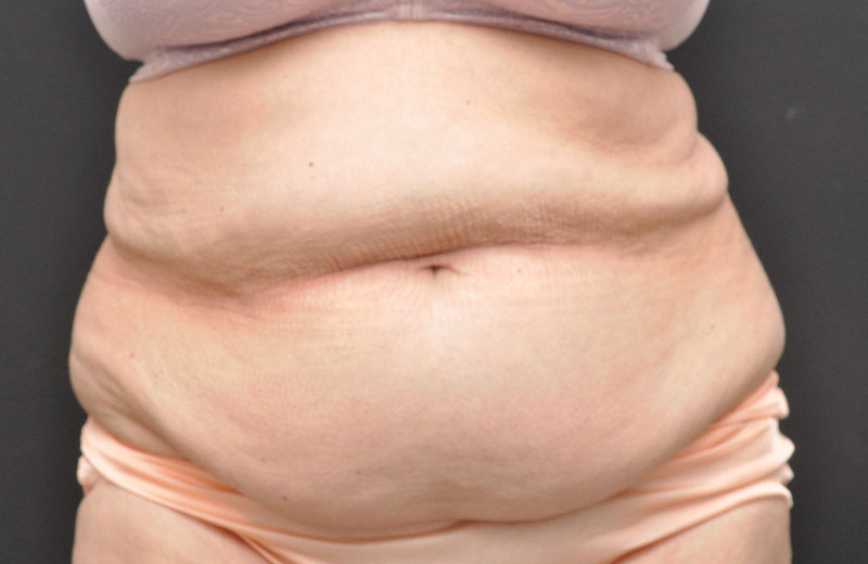 Abdominoplasty Before and After | Northside Plastic Surgery