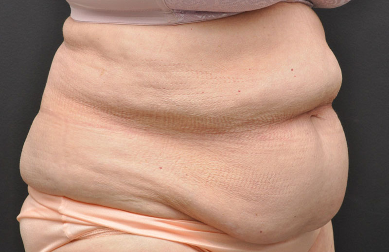 Abdominoplasty Before and After | Northside Plastic Surgery