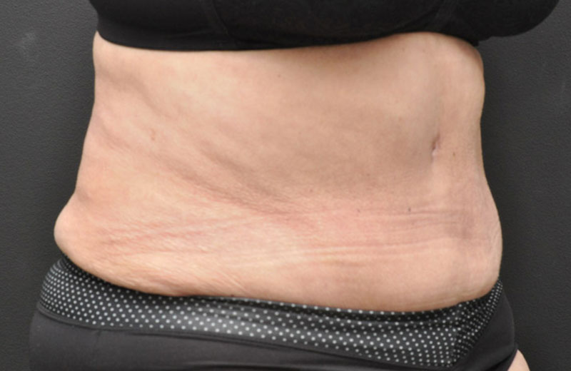 Abdominoplasty Before and After | Northside Plastic Surgery