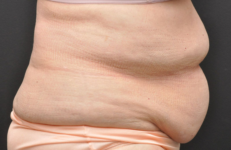Abdominoplasty Before and After | Northside Plastic Surgery