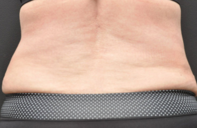 Abdominoplasty Before and After | Northside Plastic Surgery