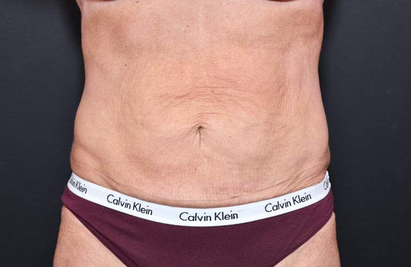 Abdominoplasty Before and After | Northside Plastic Surgery