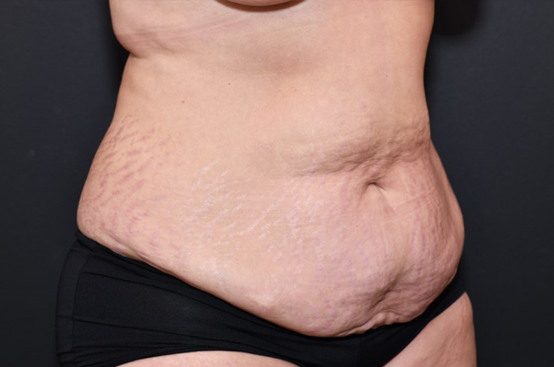 Abdominoplasty Before and After | Northside Plastic Surgery