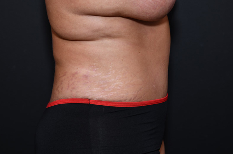 Abdominoplasty Before and After | Northside Plastic Surgery