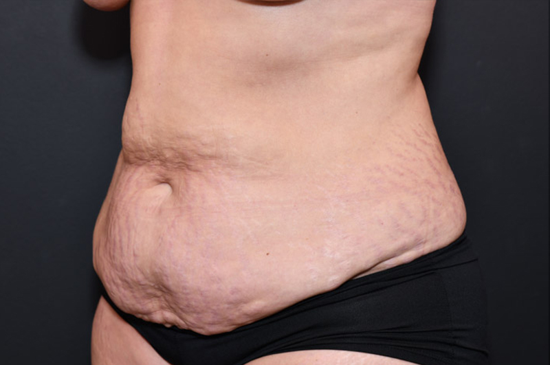 Abdominoplasty Before and After | Northside Plastic Surgery