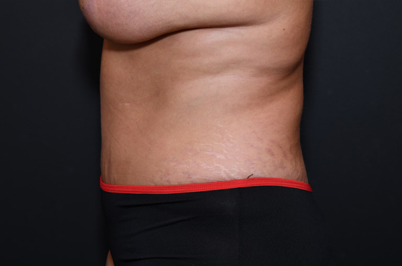 Abdominoplasty Before and After | Northside Plastic Surgery