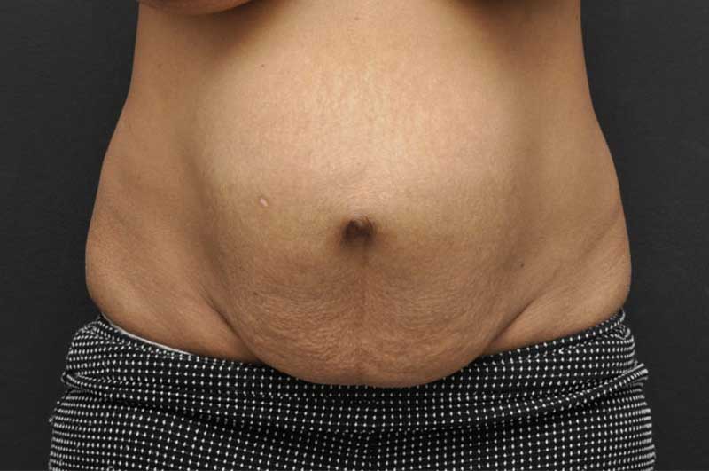 Abdominoplasty Before and After | Northside Plastic Surgery