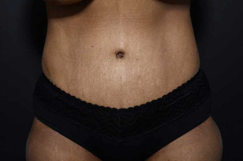 Abdominoplasty Before and After | Northside Plastic Surgery