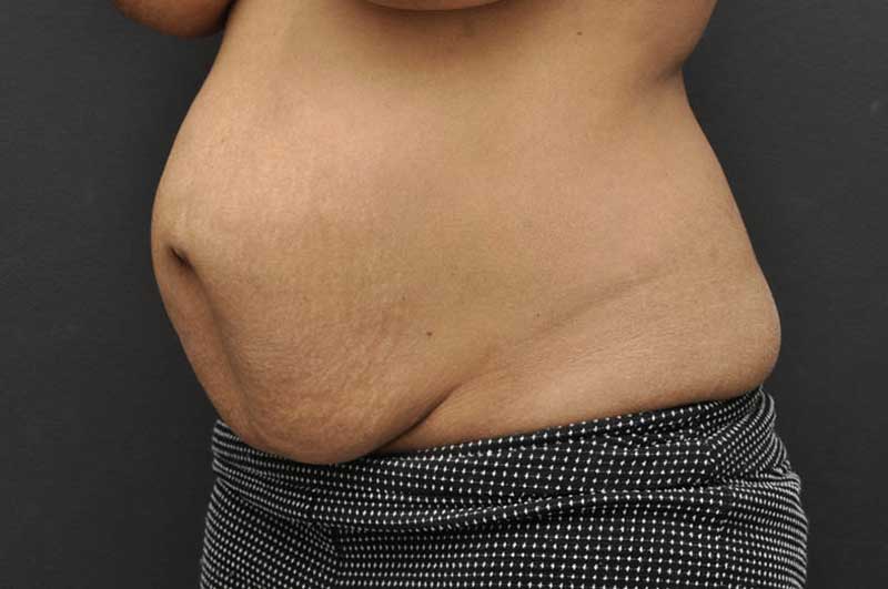 Abdominoplasty Before and After | Northside Plastic Surgery