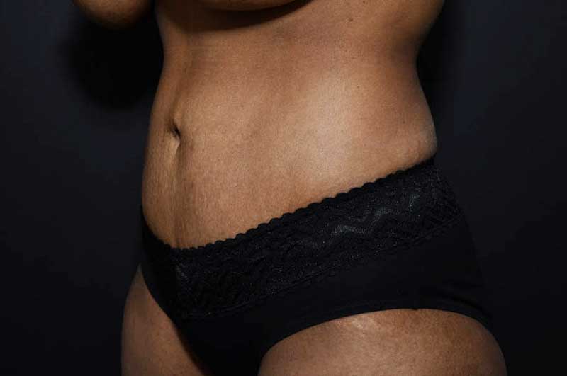 Abdominoplasty Before and After | Northside Plastic Surgery