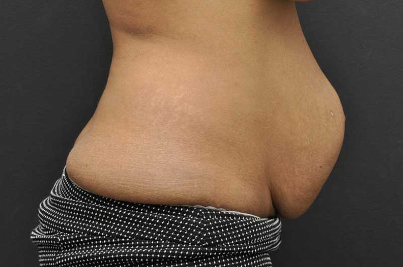 Abdominoplasty Before and After | Northside Plastic Surgery