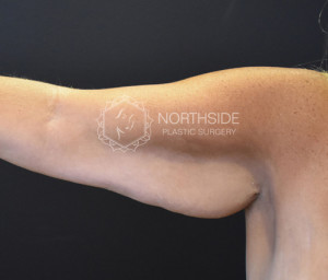 Brachioplasty Before and After | Northside Plastic Surgery