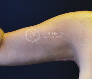 Brachioplasty Before and After | Northside Plastic Surgery