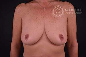 Breast Augmentation With Breast Lift Before and After | Northside Plastic Surgery