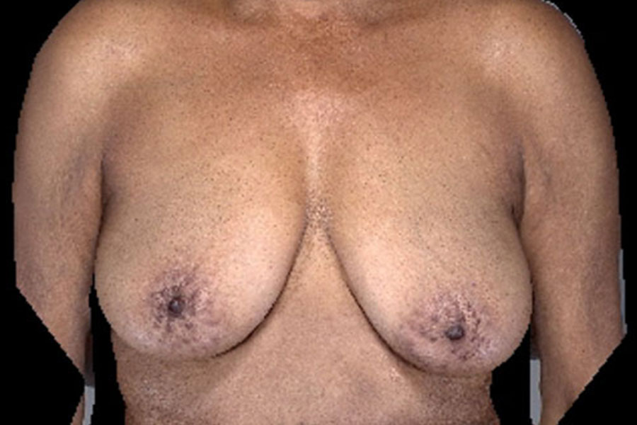 Breast Augmentation With Breast Lift Before and After | Northside Plastic Surgery