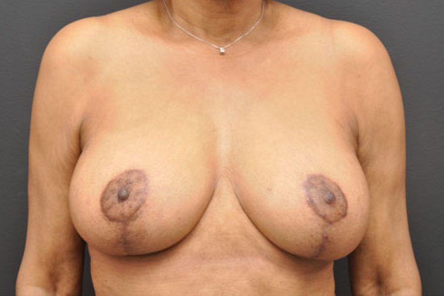 Breast Augmentation With Breast Lift Before and After | Northside Plastic Surgery