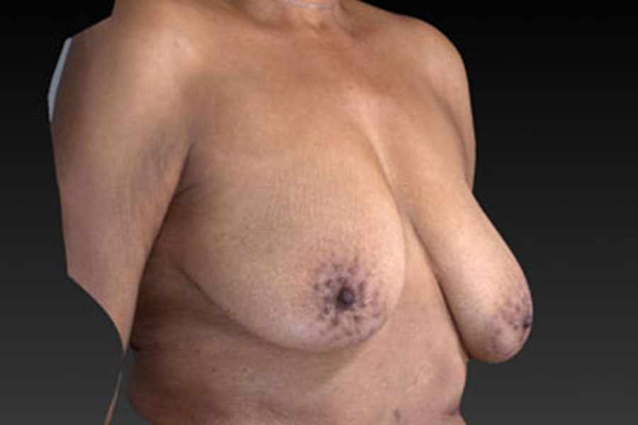 Breast Augmentation With Breast Lift Before and After | Northside Plastic Surgery