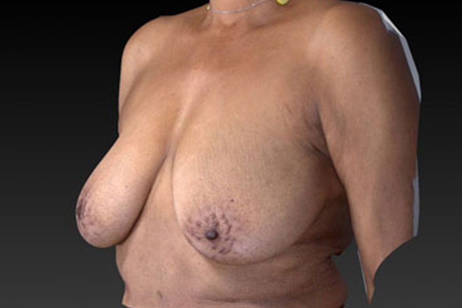 Breast Augmentation With Breast Lift Before and After | Northside Plastic Surgery