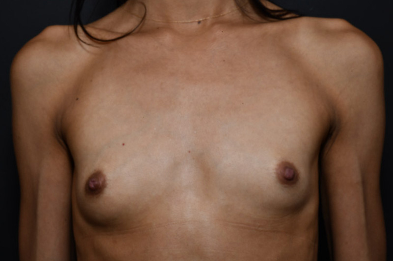 Breast Augmentation Before and After | Northside Plastic Surgery