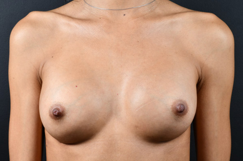 Breast Augmentation Before and After | Northside Plastic Surgery