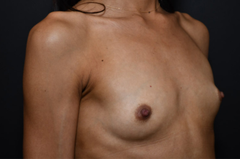 Breast Augmentation Before and After | Northside Plastic Surgery