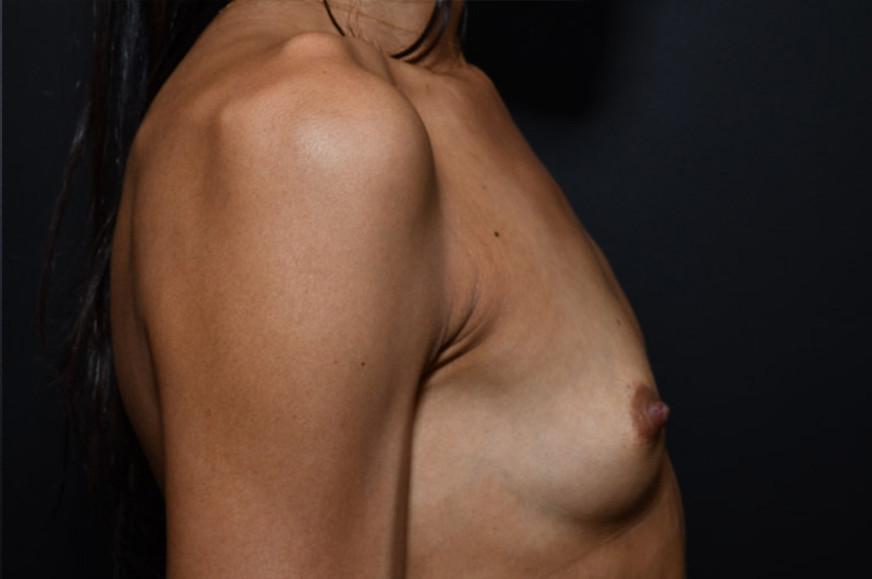 Breast Augmentation Before and After | Northside Plastic Surgery