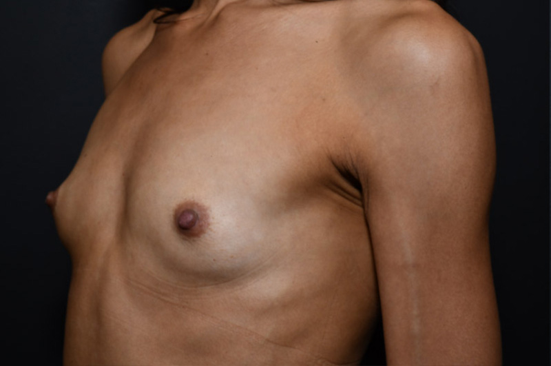 Breast Augmentation Before and After | Northside Plastic Surgery