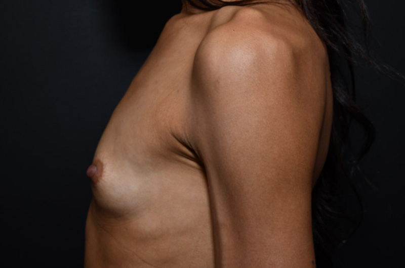 Breast Augmentation Before and After | Northside Plastic Surgery