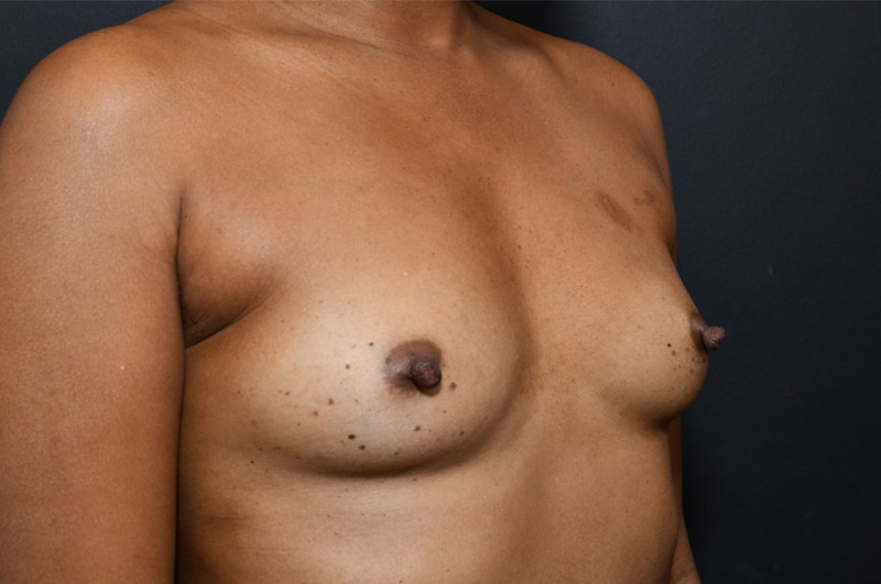 Breast Augmentation Before and After | Northside Plastic Surgery