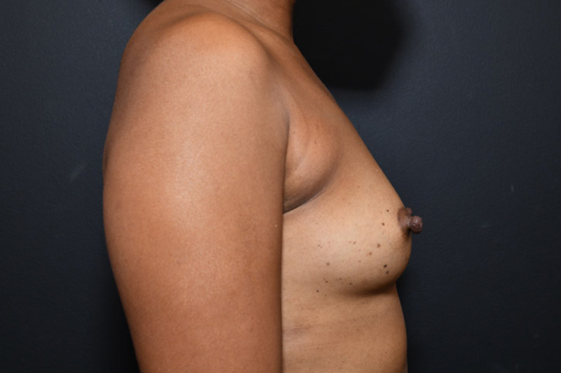 Breast Augmentation Before and After | Northside Plastic Surgery