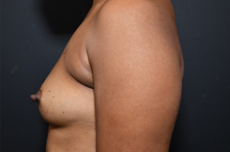 Breast Augmentation Before and After | Northside Plastic Surgery