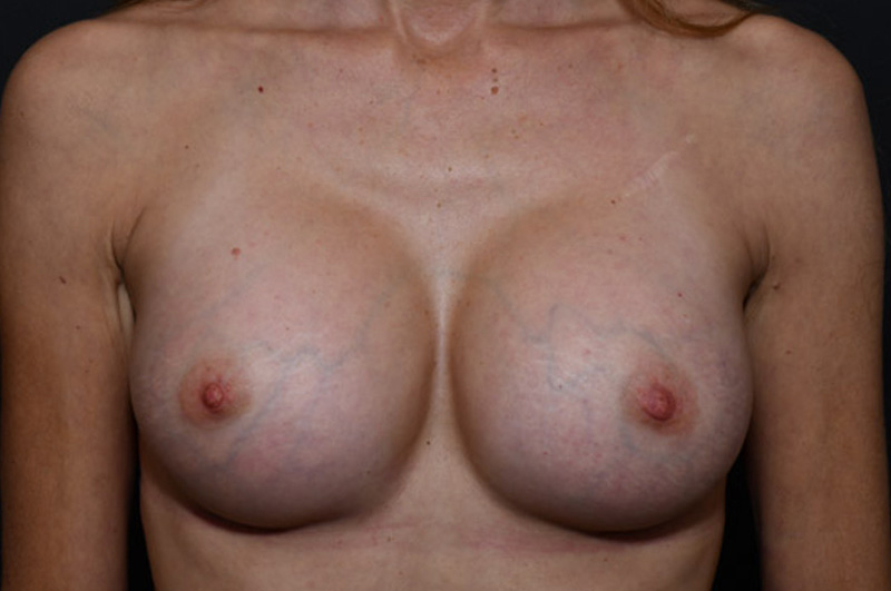 Breast Augmentation Before and After | Northside Plastic Surgery