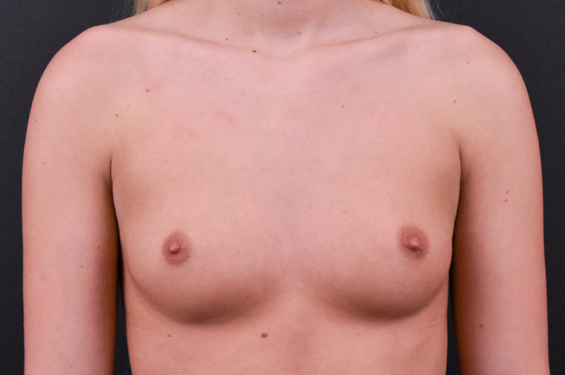 Breast Augmentation Before and After | Northside Plastic Surgery