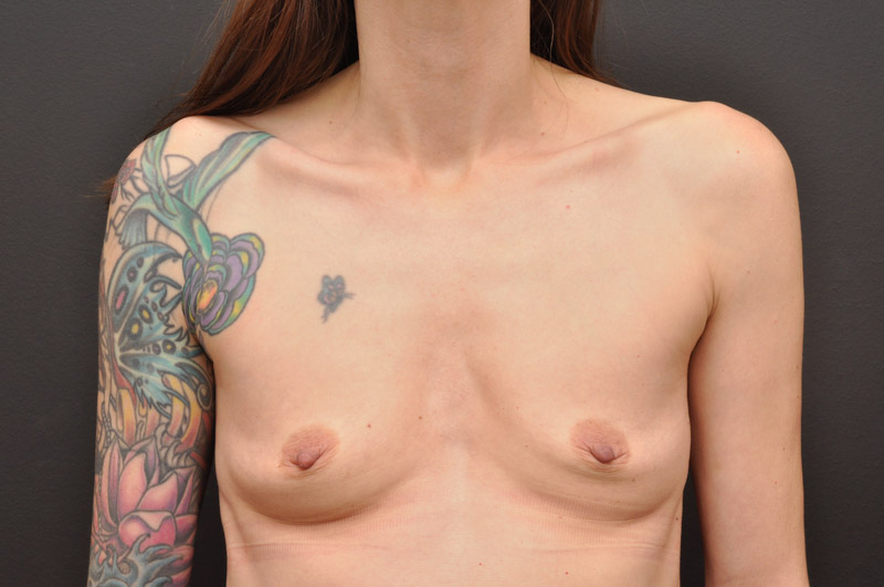 Breast Augmentation Before and After | Northside Plastic Surgery