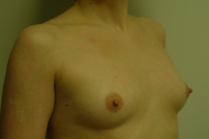 Breast Augmentation Before and After | Northside Plastic Surgery