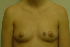 Breast Augmentation Before and After | Northside Plastic Surgery