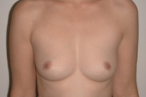 Breast Augmentation Before and After | Northside Plastic Surgery