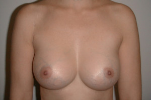 Breast Augmentation Before and After | Northside Plastic Surgery